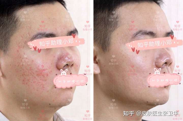 点阵激光真是的三次之后才会效果明显吗?