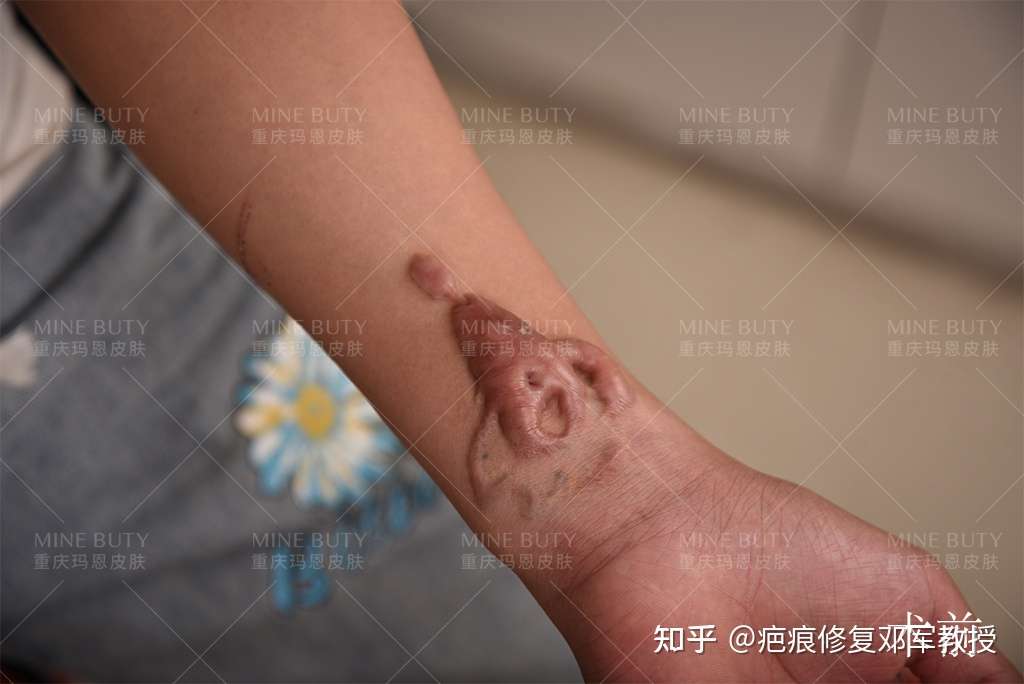 纹身引起的疤痕疙瘩,虽… - 知乎