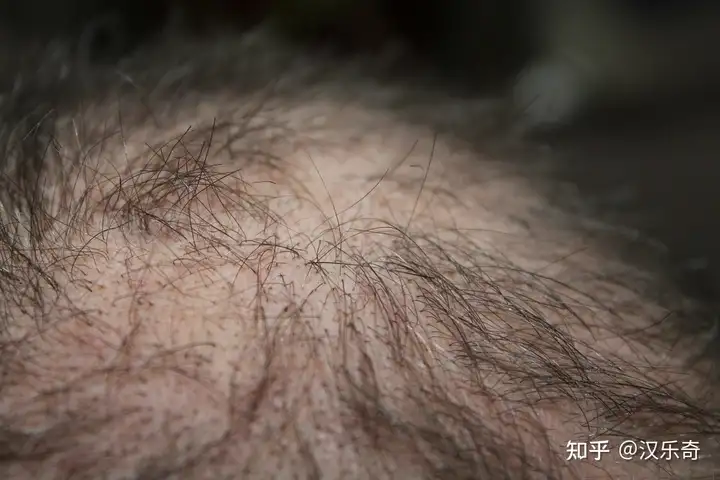 宝宝头上出现钙圈的原因是什么? - 知乎
