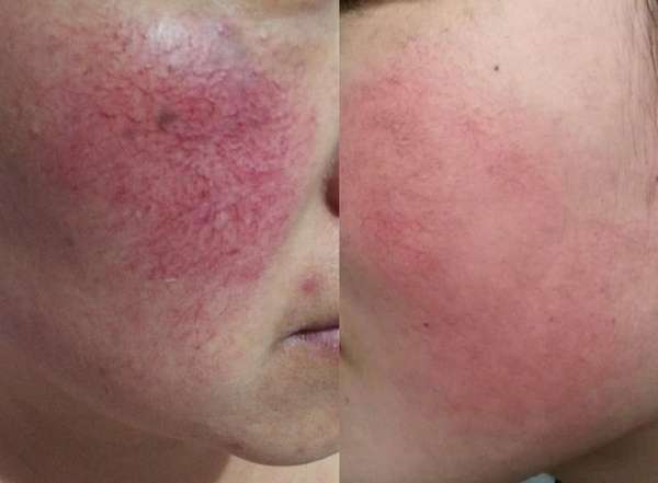 敏感肌到底是怎么来的?