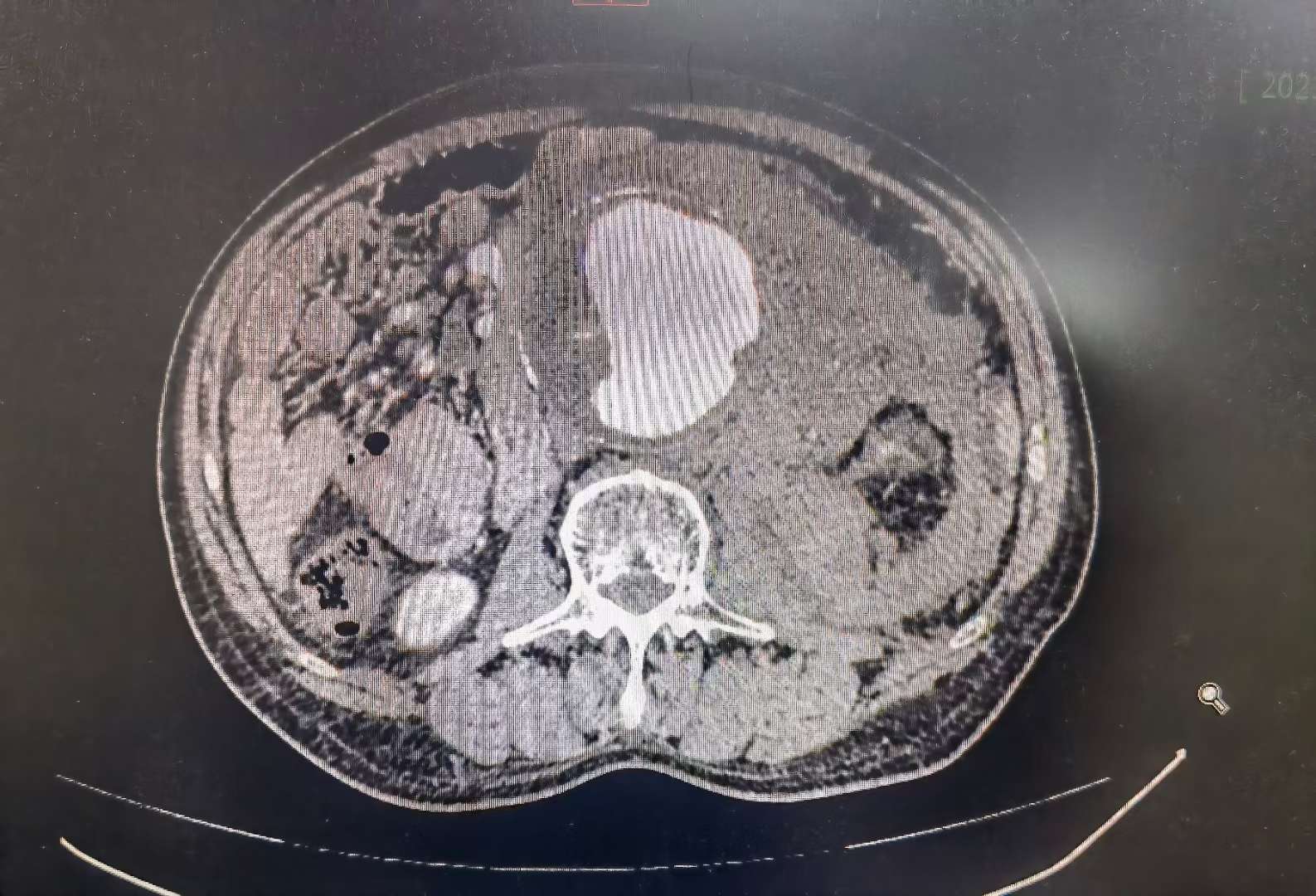 yinan li 的想法: 急诊腹主动脉瘤破裂,从鬼门关外面把人拉… - 知乎