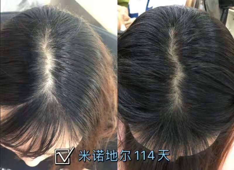 康永青 的想法: 使用米诺地尔114天效果 发缝稀疏改善,实… - 知乎