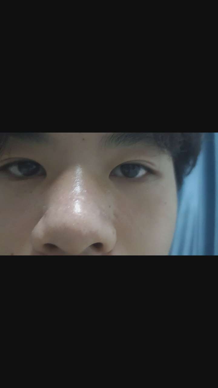 我鼻子上长得痘 差不多两年了 现在成疤痕了 长痘