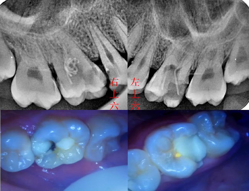 六号牙医 的想法: 左上六号牙,右上六号牙,两颗外院做的根… - 知乎