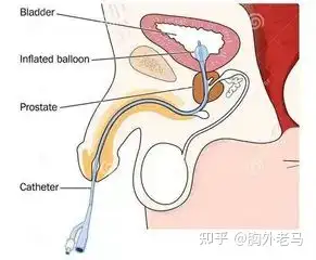 拔尿管流程图图片