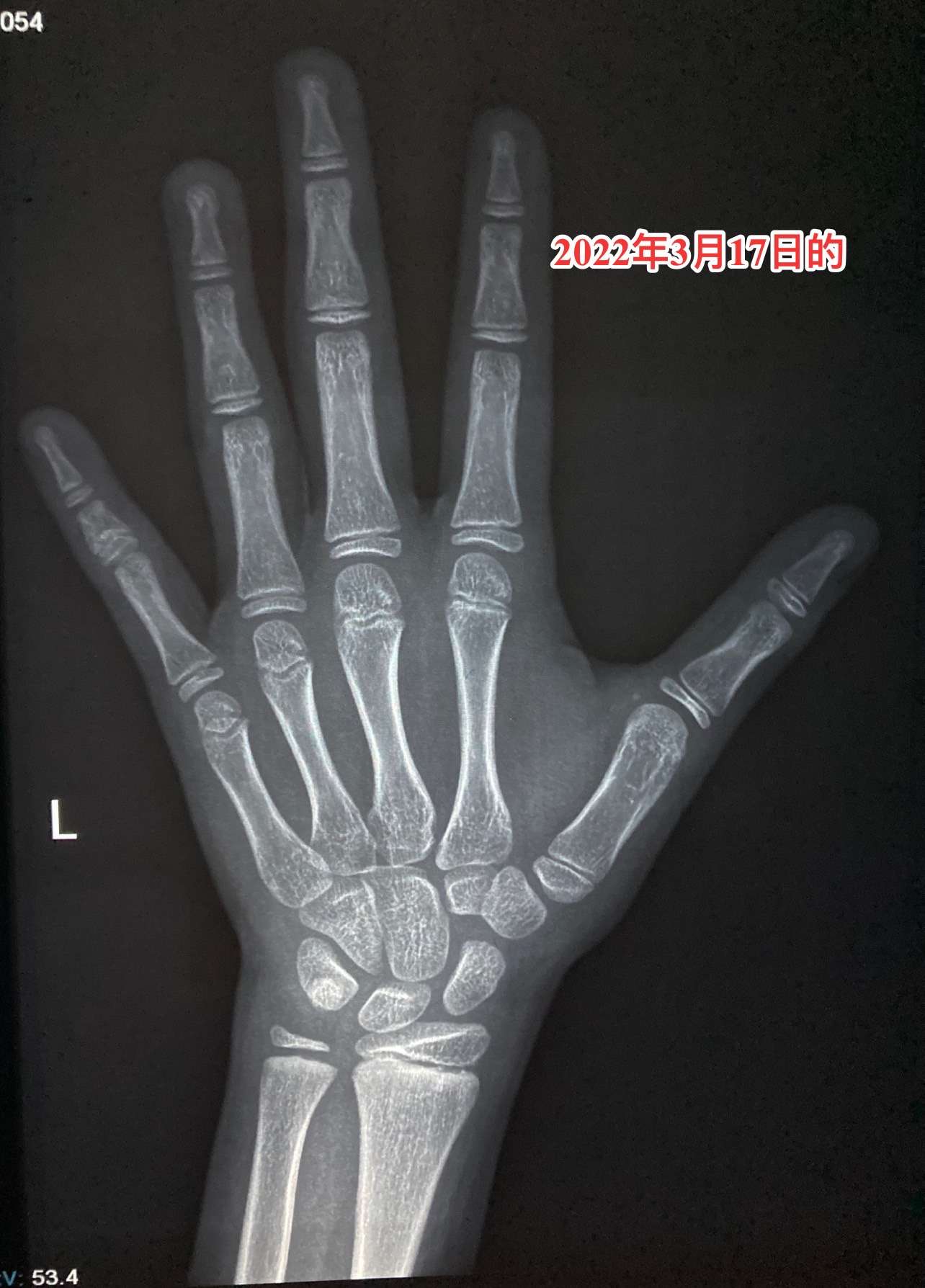 骨龄鉴定徐永剑 的想法: 差点又被骗了,籽骨出现不一定是11岁骨龄