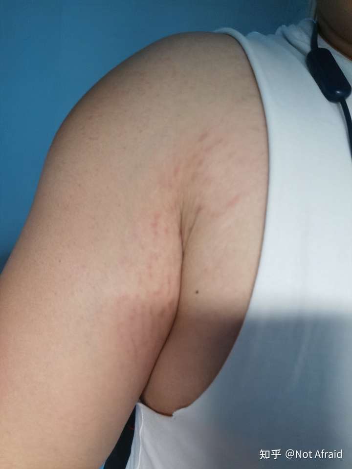 因健身产生的膨胀纹怎么处理?