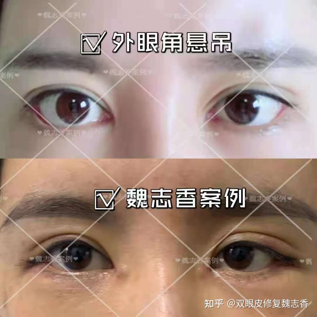 双眼皮修复魏志香 的想法: 今日分享案例: 外眼角悬吊,解决因手术