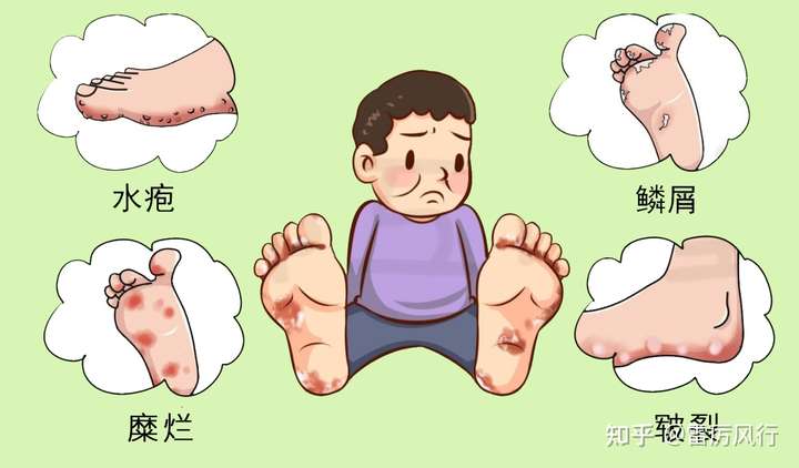 脚气都会很痒吗?