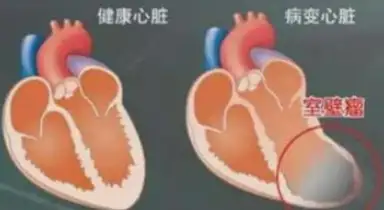 得了心肌梗塞并发左心室室壁瘤有哪些明显症状?