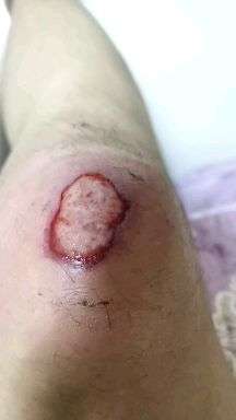 伤口发白怎么回事? - 知乎