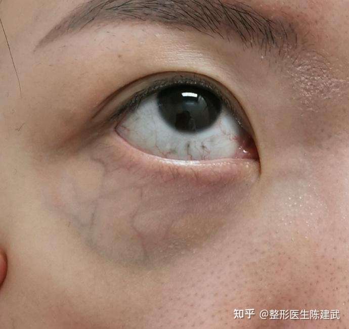 黑眼圈经常伴随着眼袋尤其以血管性黑眼圈最为常见