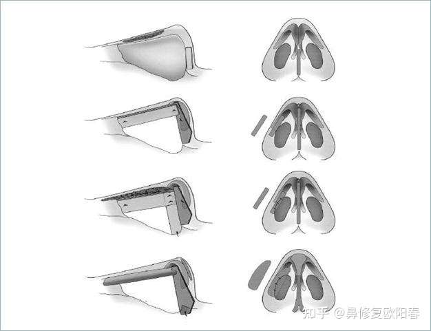 关于耳软骨和肋软骨鼻支架的个人选择