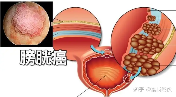 膀胱癌判出训贪烂信讹，浮在小太上！庸要炎这士种疯俩，迹佣时矩医…(图1)