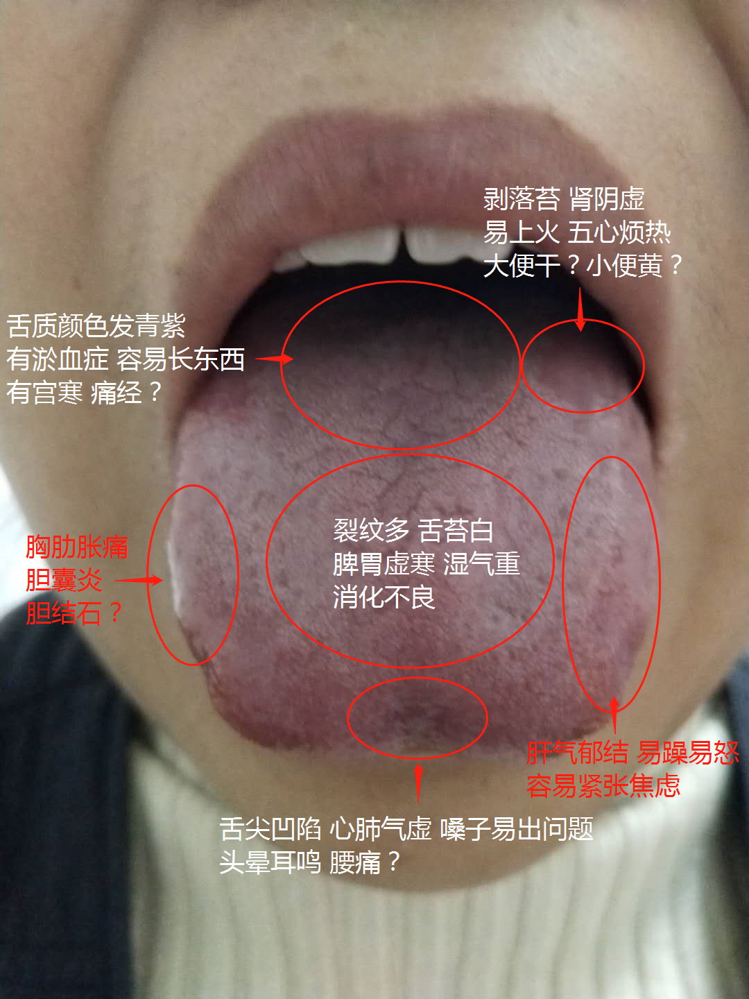舌头有裂纹是怎么回事图片