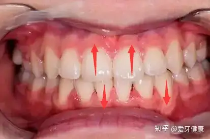 正畸中压低阶段是指什么