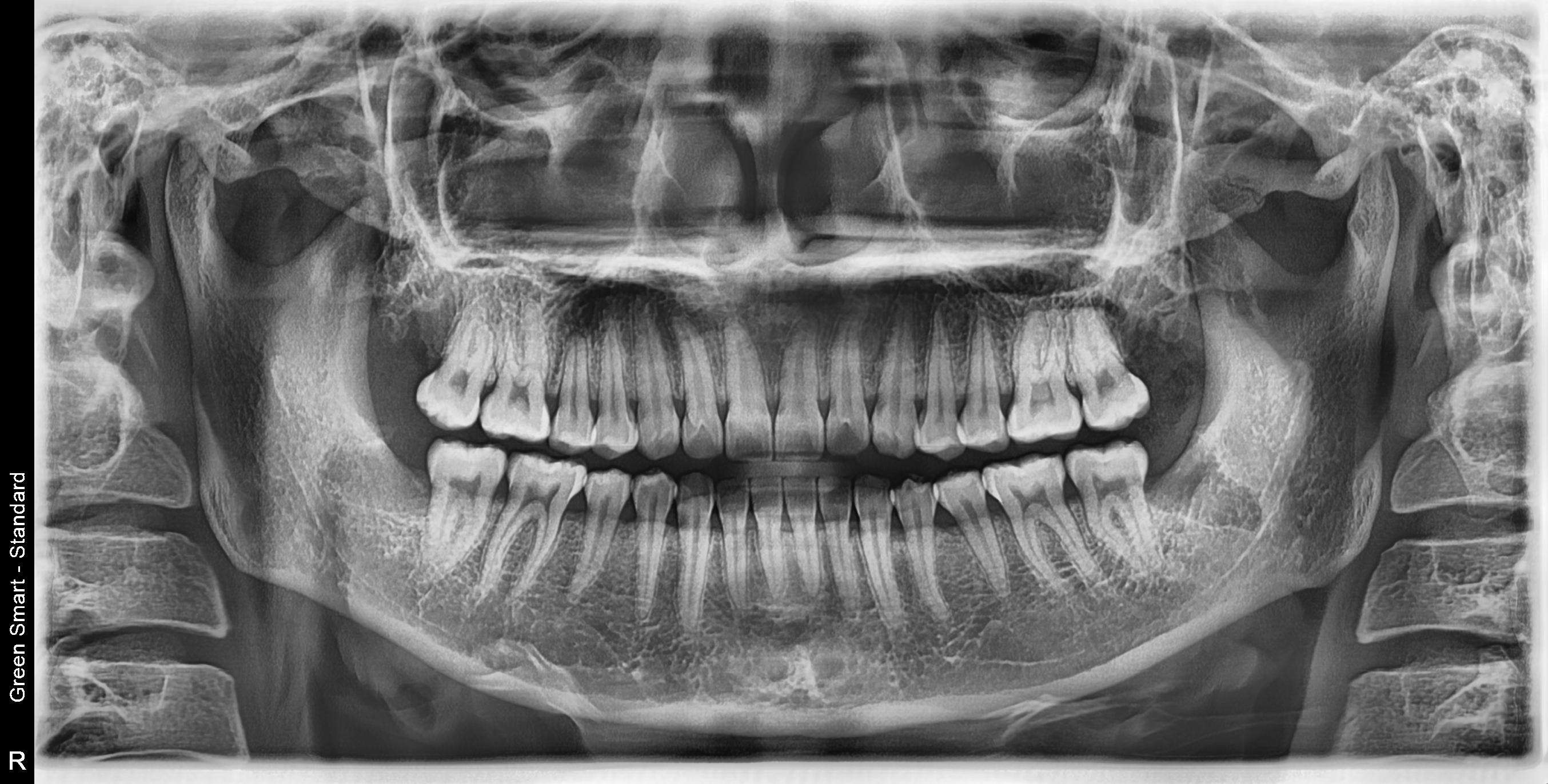 李彦德-成都牙医 的想法: 智齿拔完之后的清爽,从x片上都能直观的
