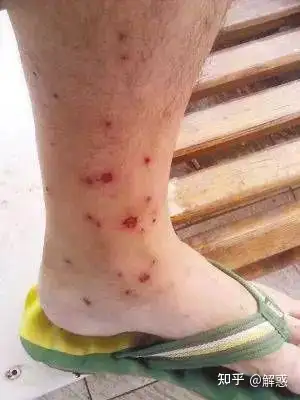 有没有办法鉴定包是跳蚤咬的还是蚊子咬的