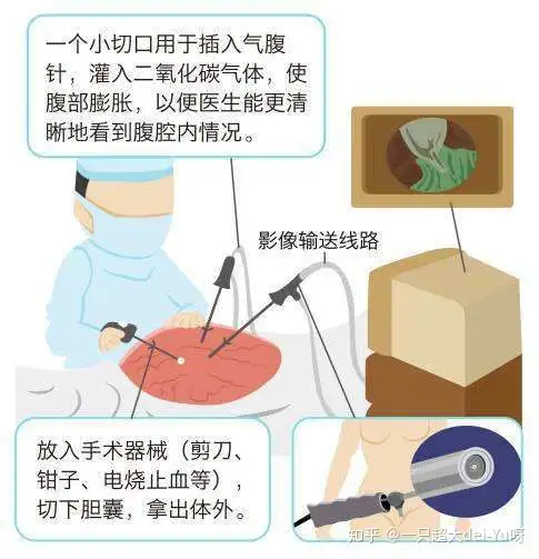 为何微创腹腔镜手术后,肚子会变鼓鼓的? - 知乎
