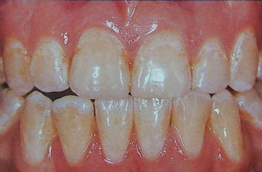 牙釉质发育不完全是怎么变成这样的?换牙会好吗?四岁半孩子?
