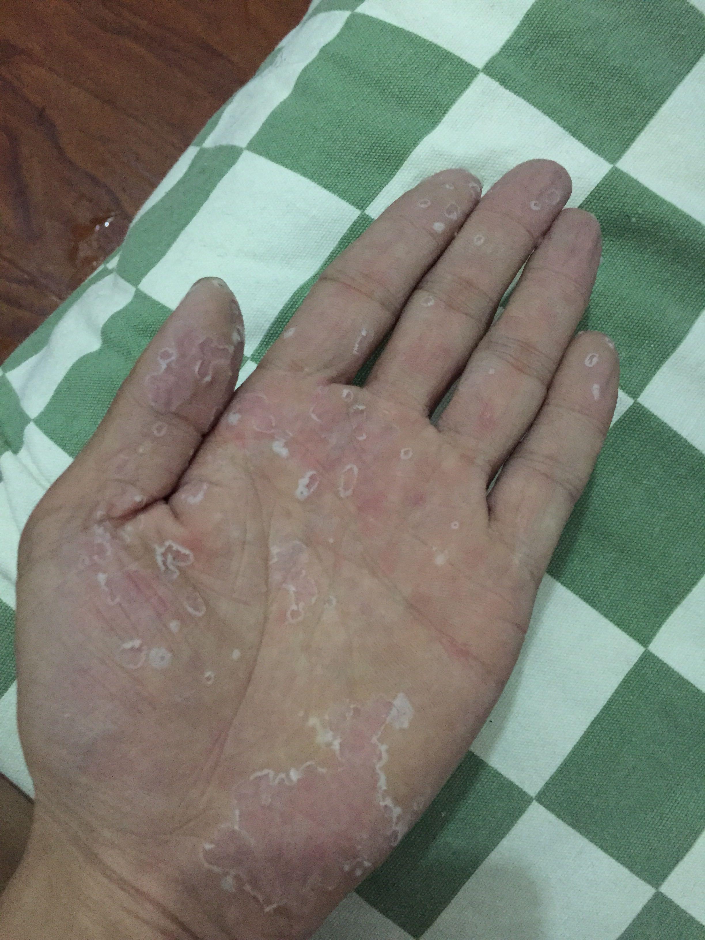 季节性手脱皮什么原因有什么方法可以根治吗