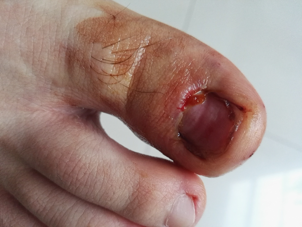 拔指甲是什么样的体验?很疼么?