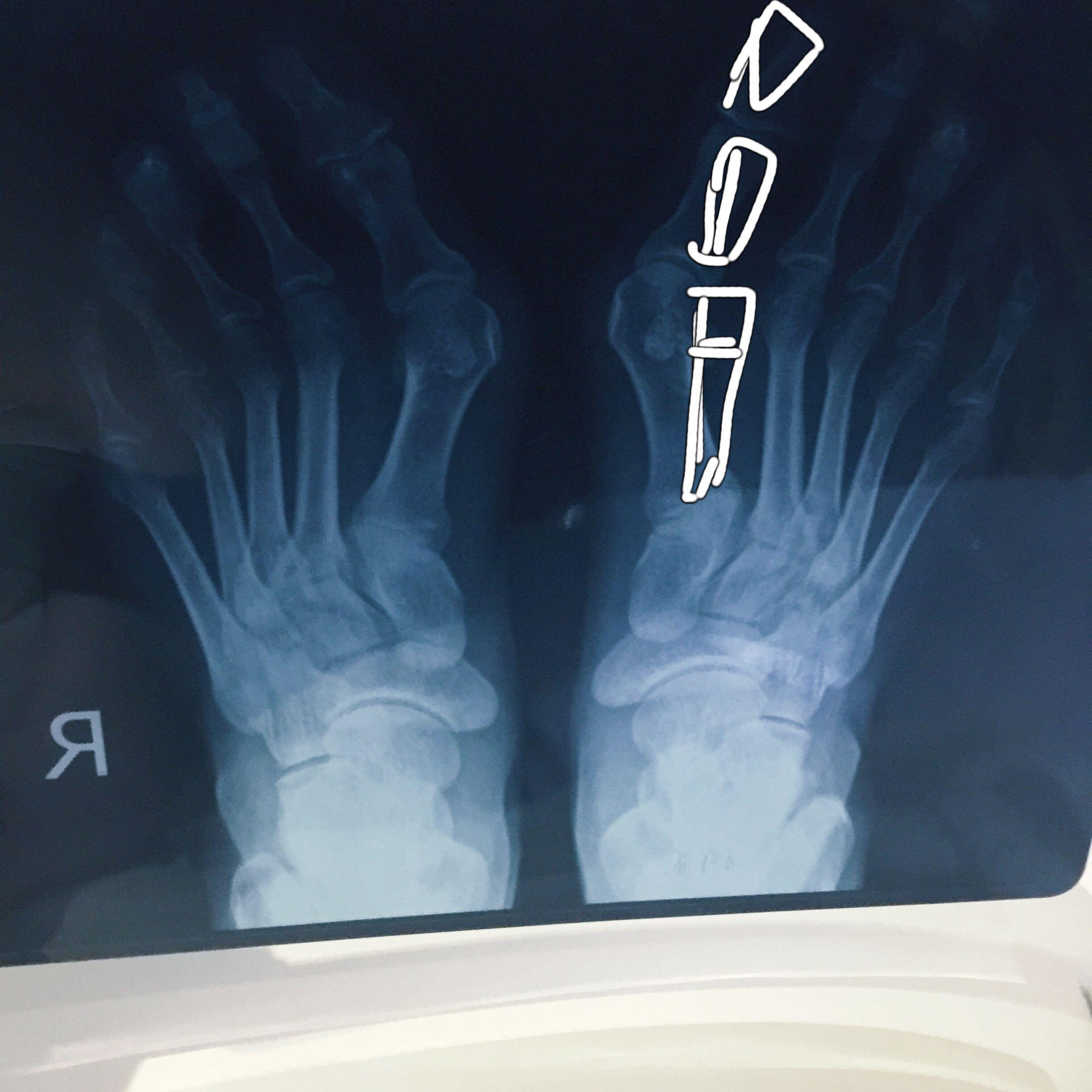 女生脚趾拇外翻是什么样体验? - 知乎