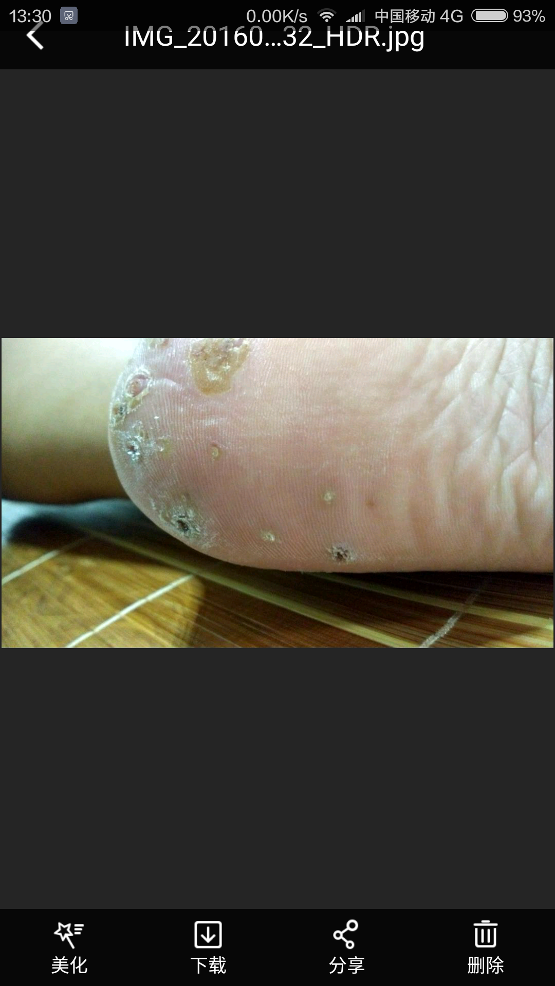 跖疣和鸡眼有什么区别医学上有没有什么治疗跖疣的好办法