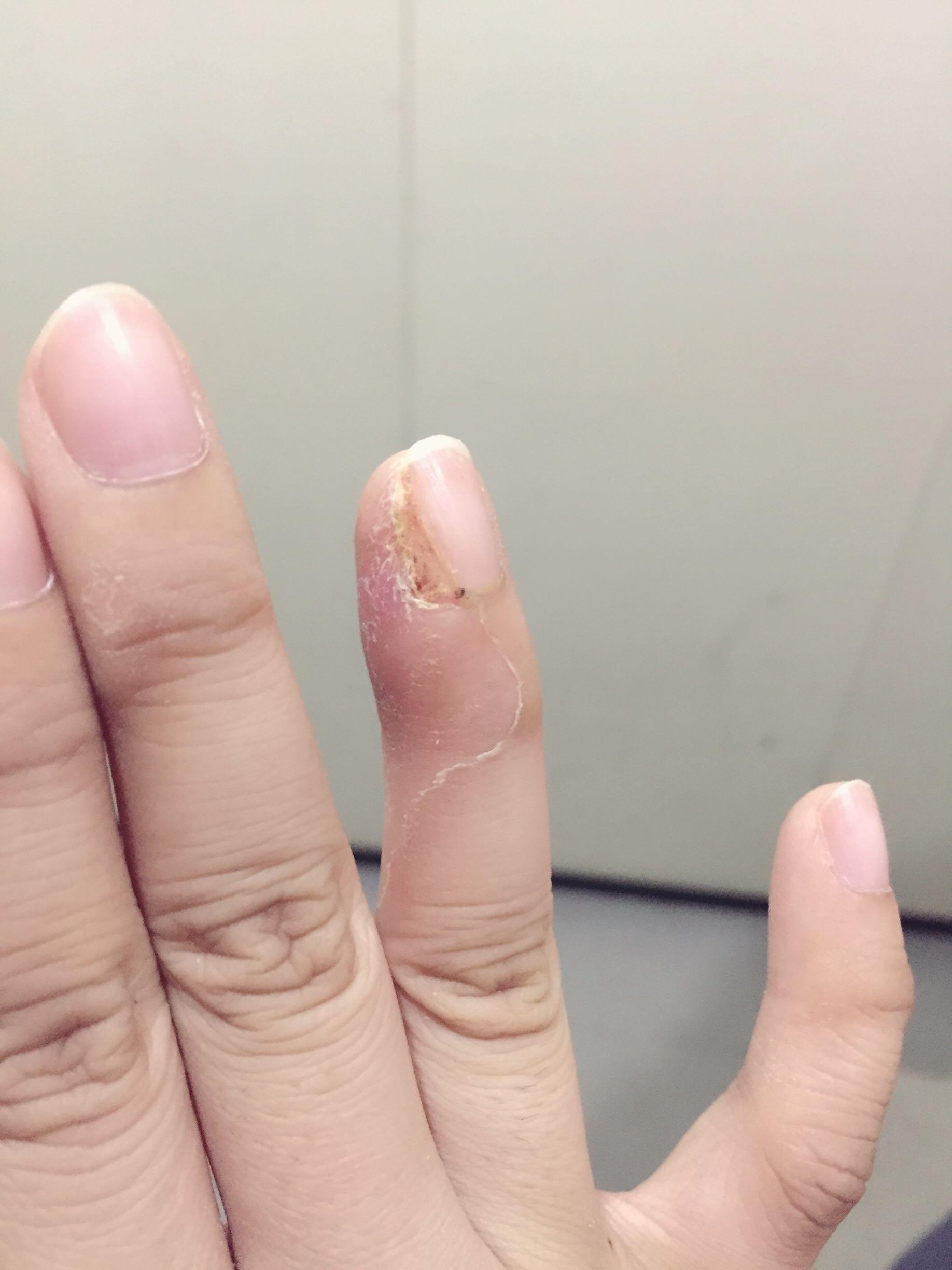 拔指甲是什么样的体验?很疼么? - 知乎