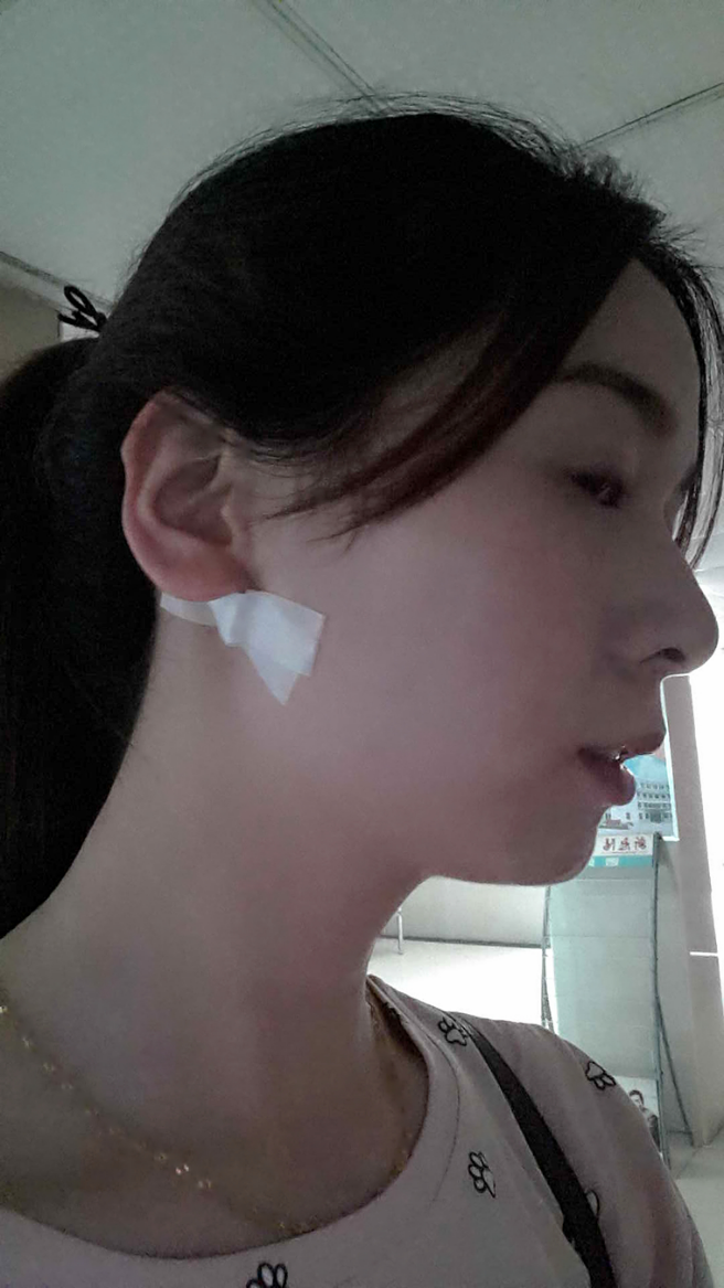 耳朵后面长了个包,医生说是皮脂腺囊肿,不想开刀,有没有什么偏方能