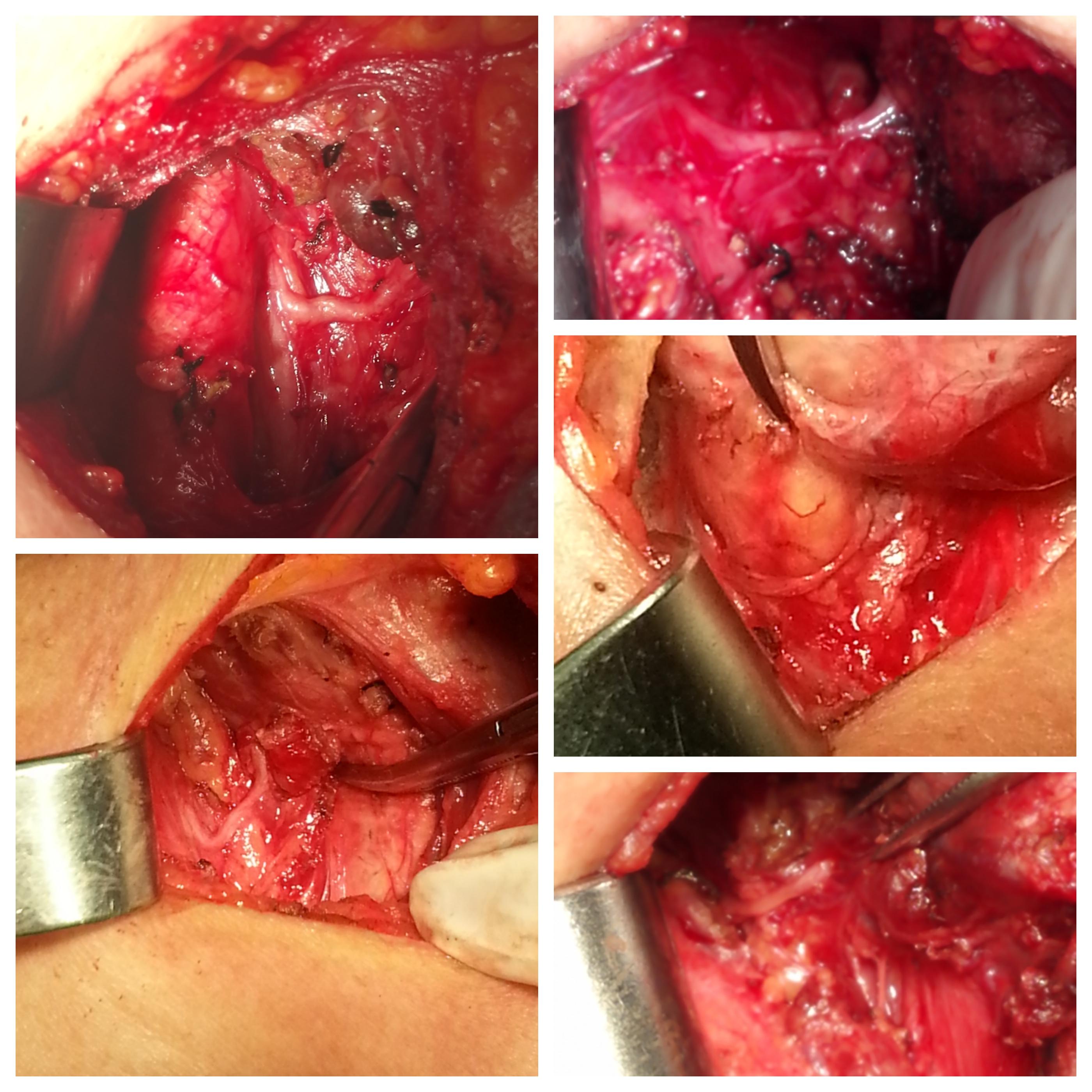 甲状腺结节怎么确诊良性还是恶性? - 知乎