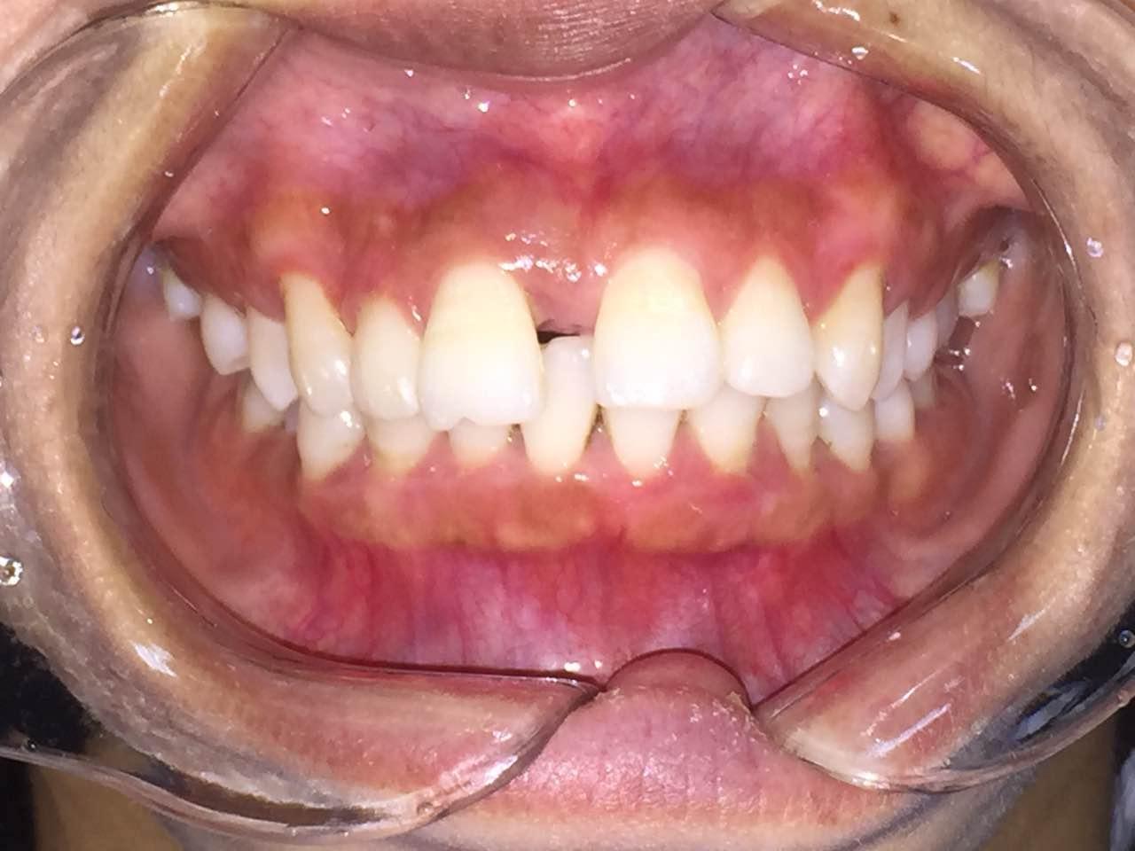 牙医们请看看我的牙齿咬合问题我咬门牙后面的牙咬合不起来咬后面下巴