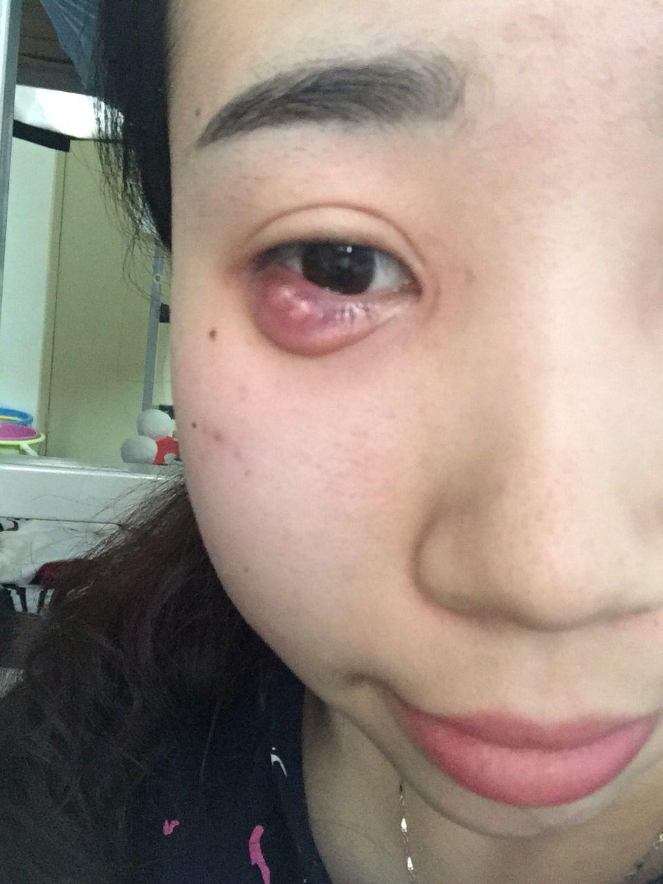 麦粒肿要多长时间好? - 知乎