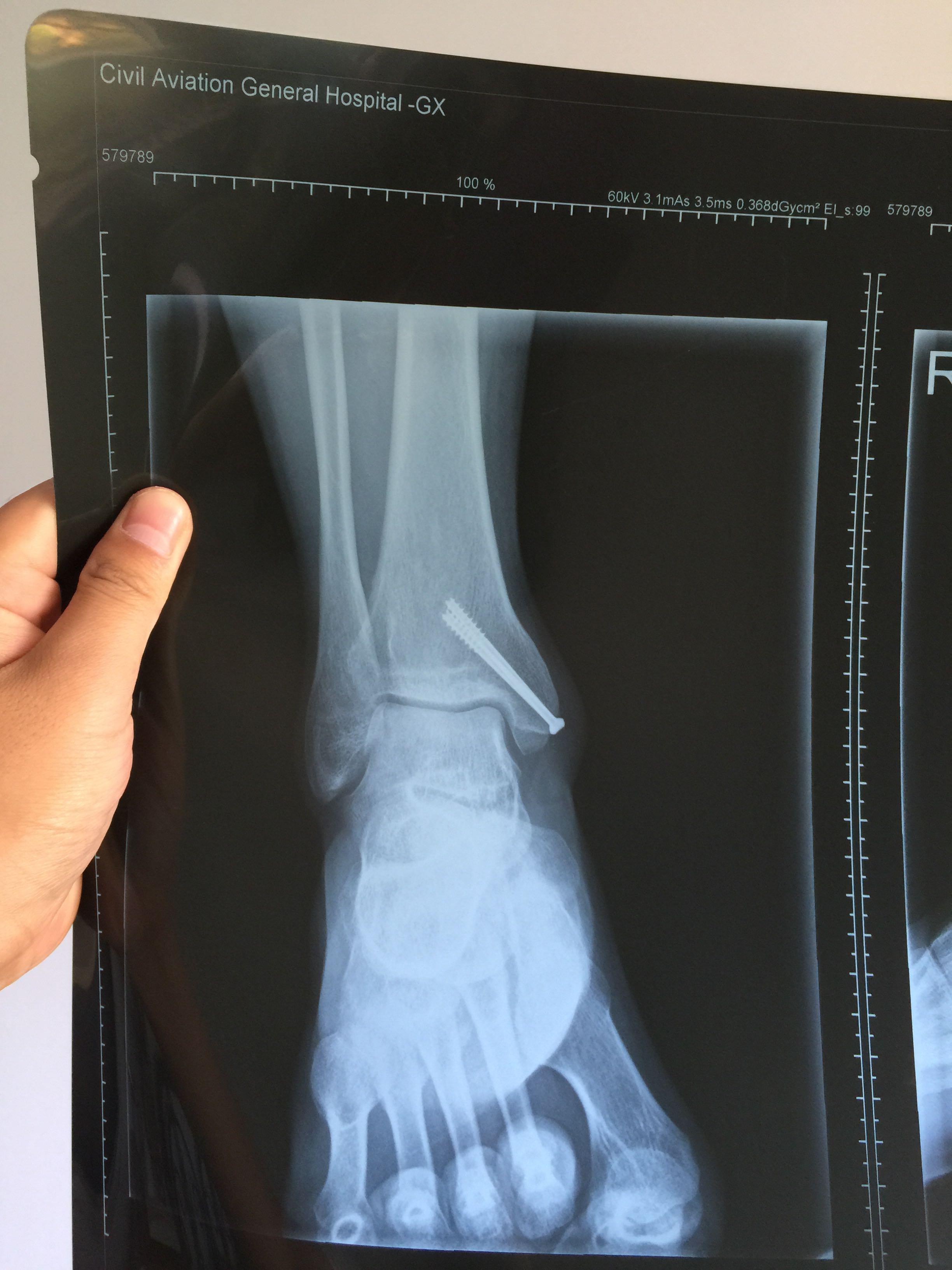 右内踝骨折,现在打石膏保守治疗,有什么治疗建议吗? 