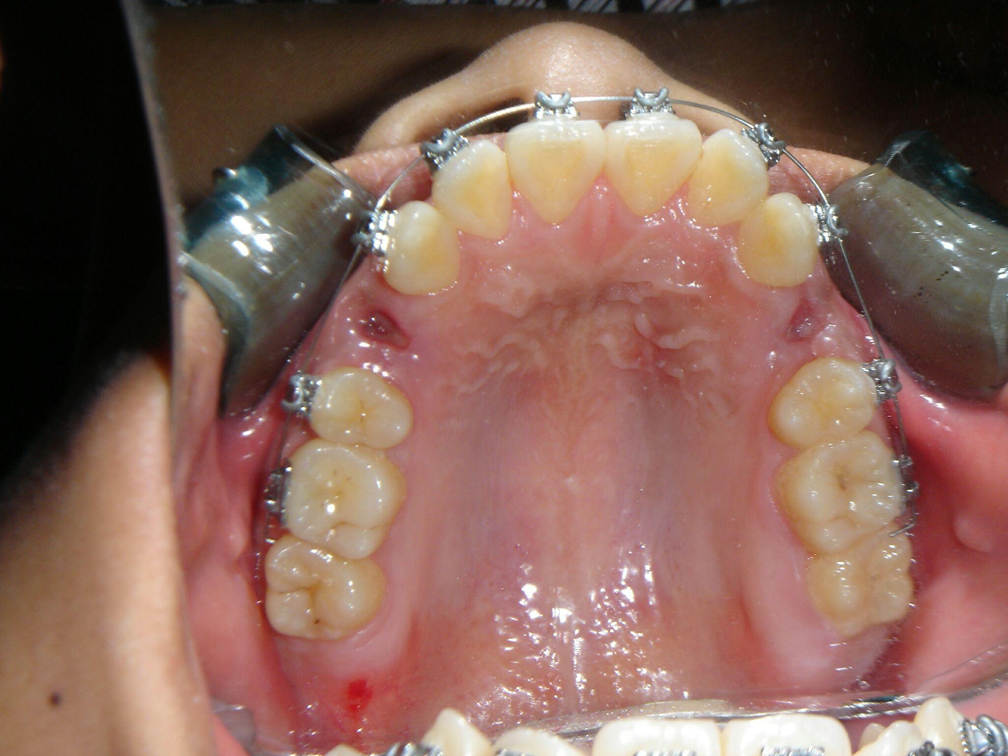 活动翼矫正器与其他矫正器的区别是什么?其优缺点呢?