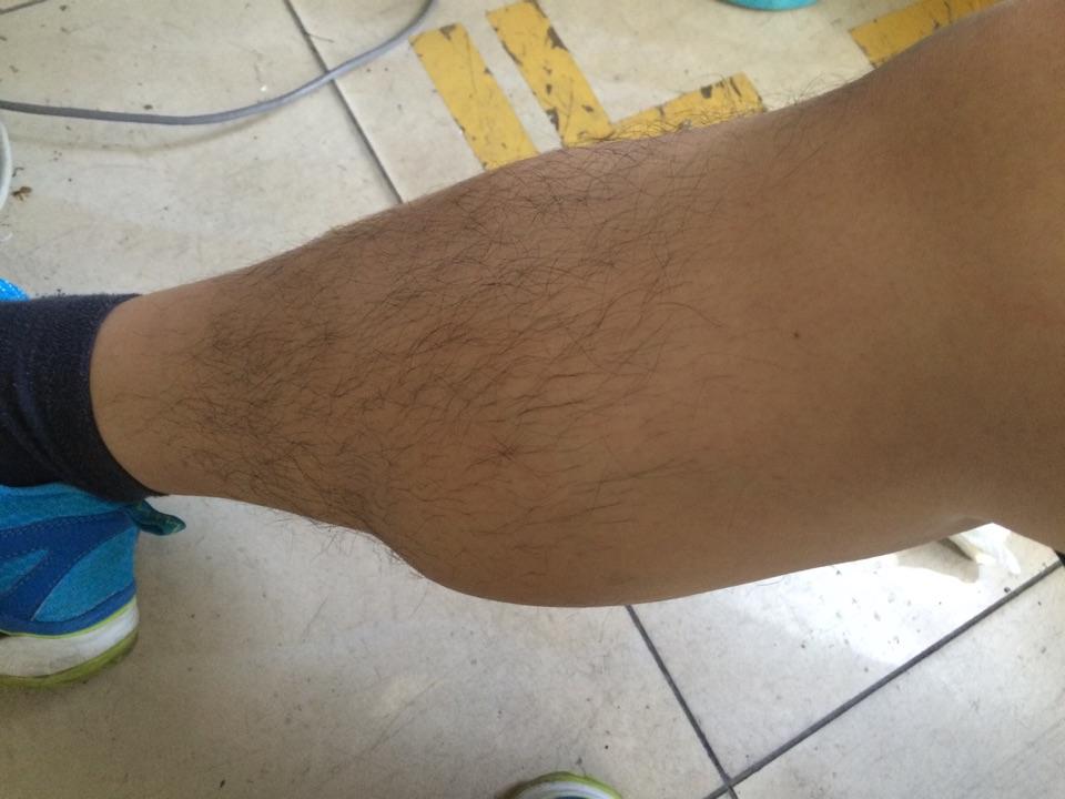 小腿肌肉凸出来一大块是什么鬼! - 知乎
