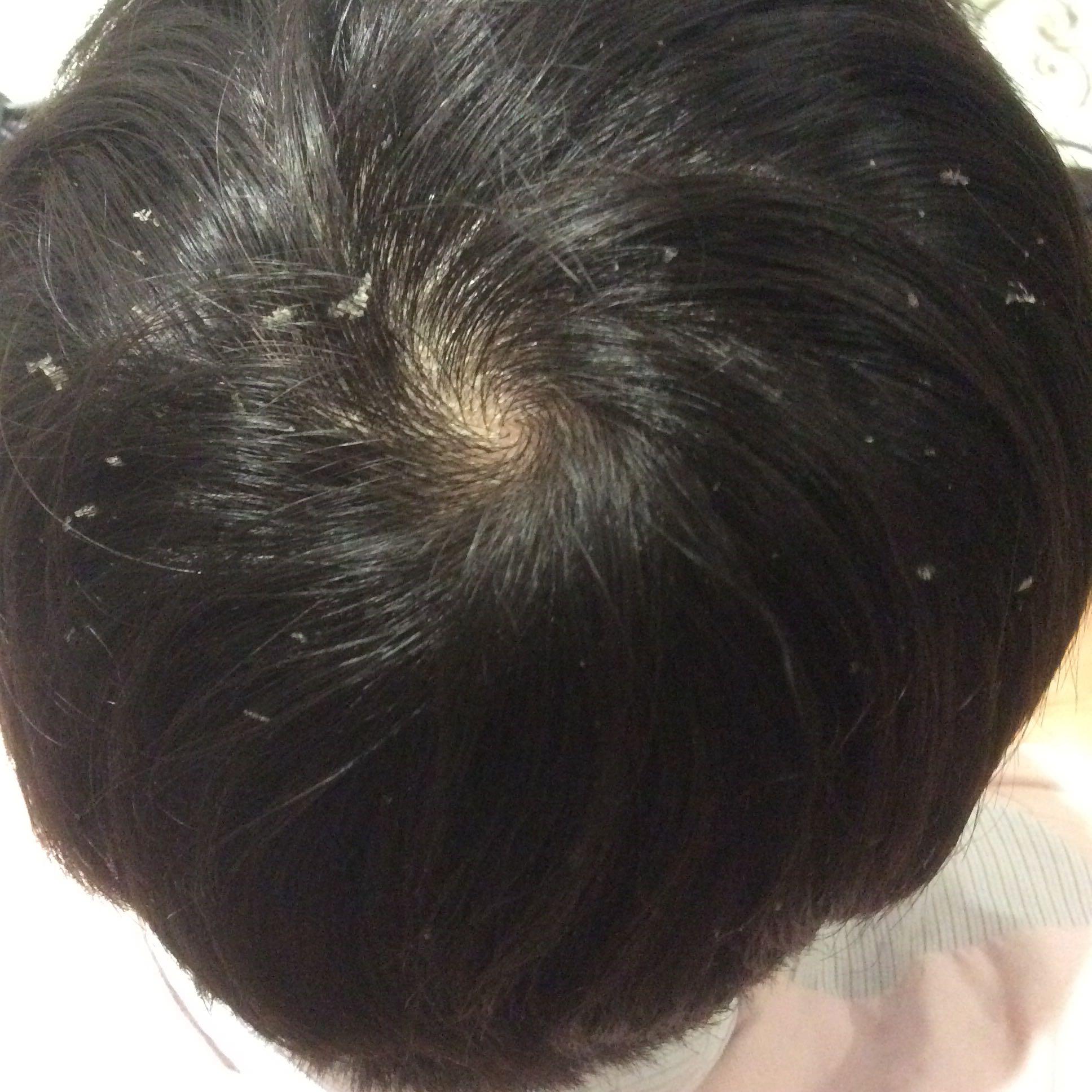 头皮屑很大块,用米醋洗的效果不持久怎么办?