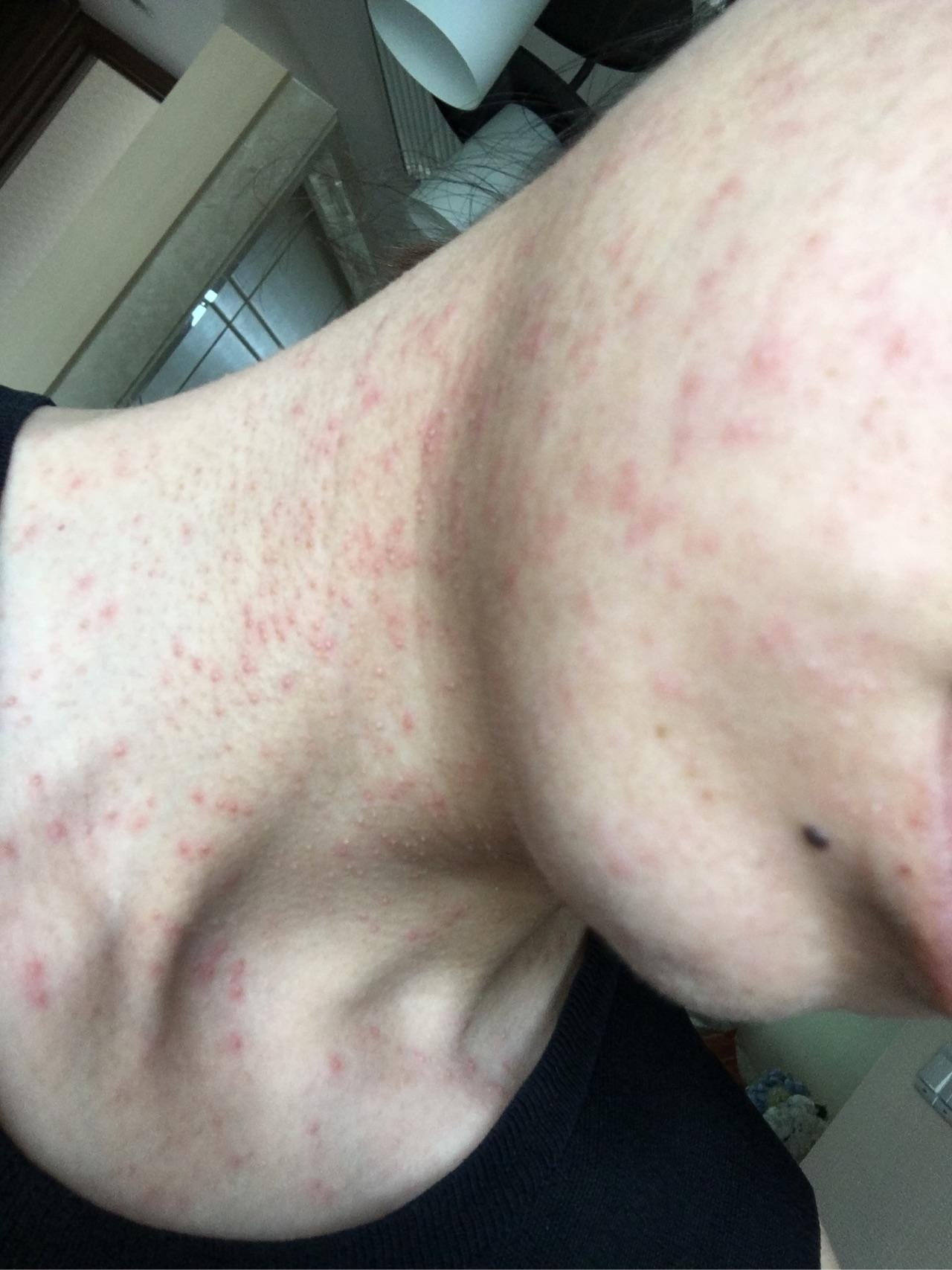 长了红色的疹子先是变红然后有小水泡然后水泡变白色的没有连成片脖子