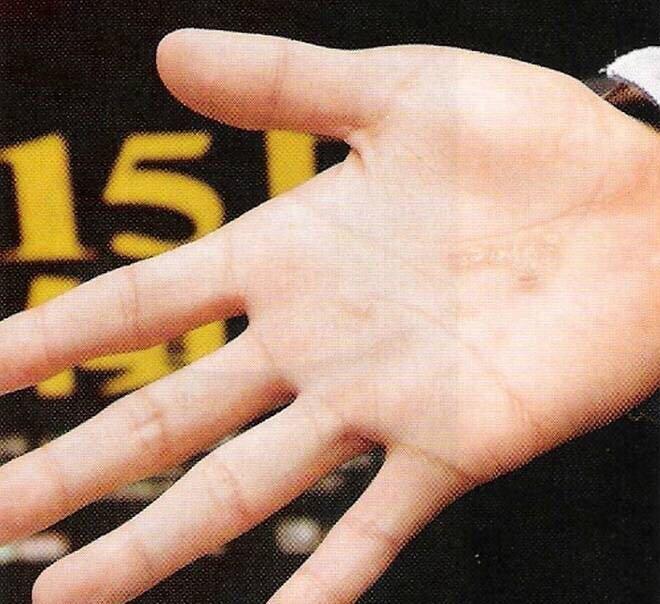 据说刘烨手上有烟头烫伤疤痕特意百度什么都没有特来请教问题如下