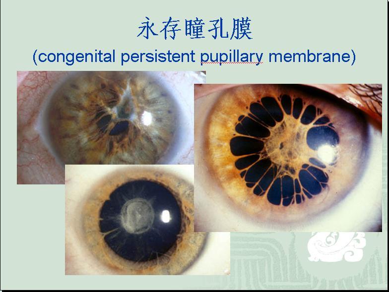 历史上的重瞳子是真实存在的吗？两个瞳仁在眼睛里是如何分布的？ - 知乎
