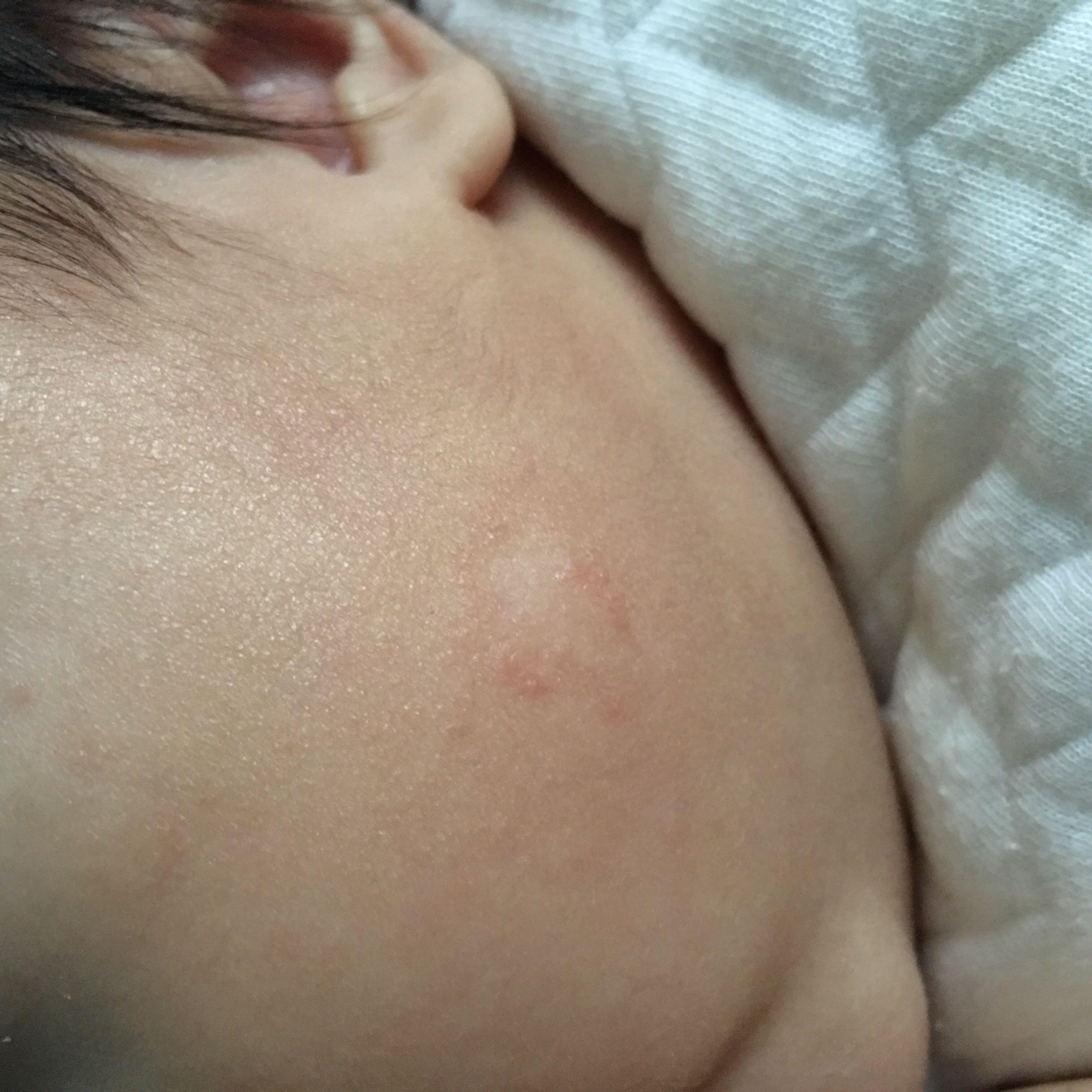 请问宝宝脸上本来长了像湿疹的东西,退掉以后那一块皮肤变白了…有人