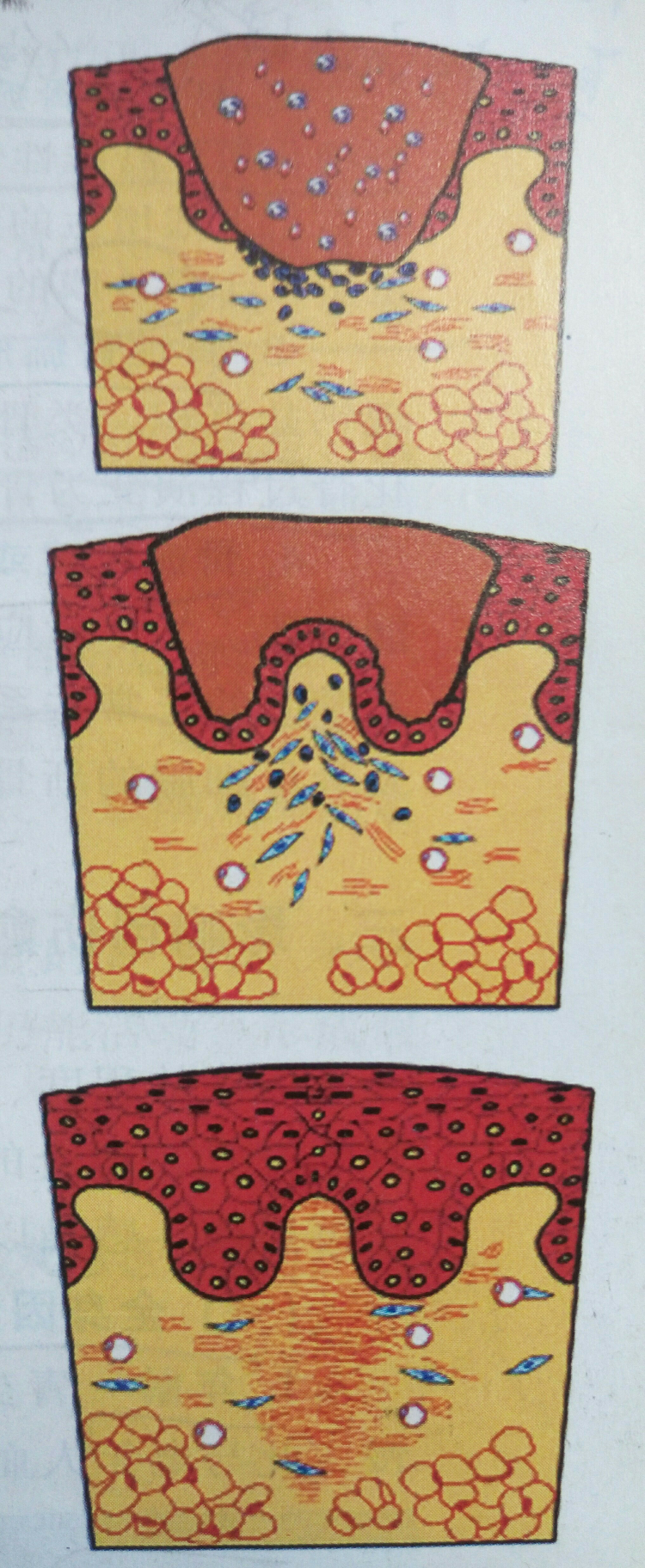 伤口愈合过程是怎样的