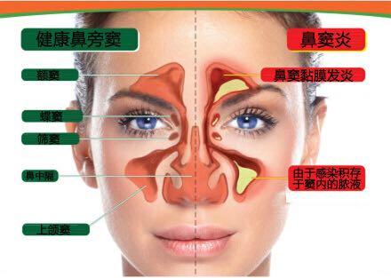 額竇炎鼻竇炎和篩竇炎需要進行手術嗎另外這些病症的成因是什麼會影響