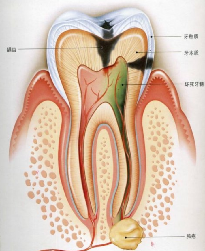 根管治疗是怎样的流程? 