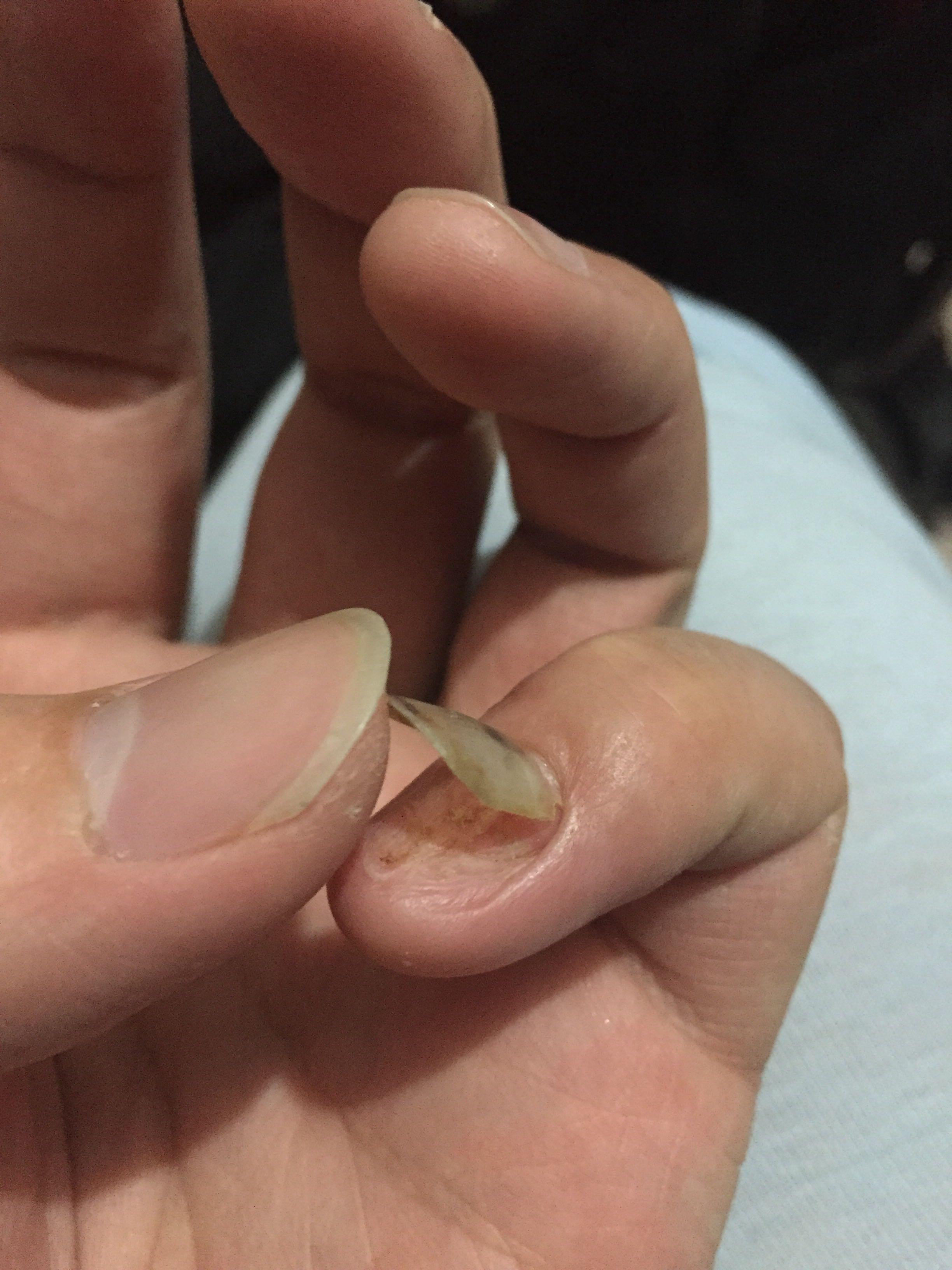 指甲被连根拔起是什么体验?