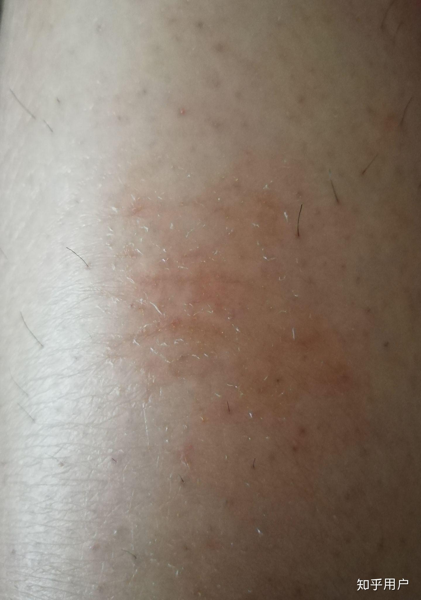 小腿内侧皮肤干燥还开裂一片红还结痂这是什么情况之前小腿处满是经络