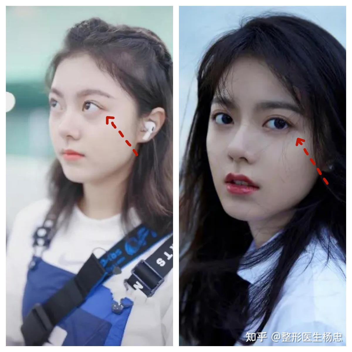 如何才能像赵金麦一样逆袭肿泡眼、凸眼球？ - 知乎