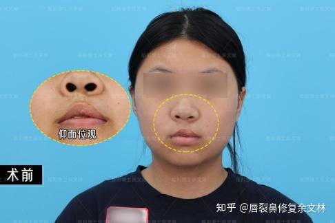 【案例分析】少见!没有出现鼻孔不对称的唇鼻继发畸形 - 知乎