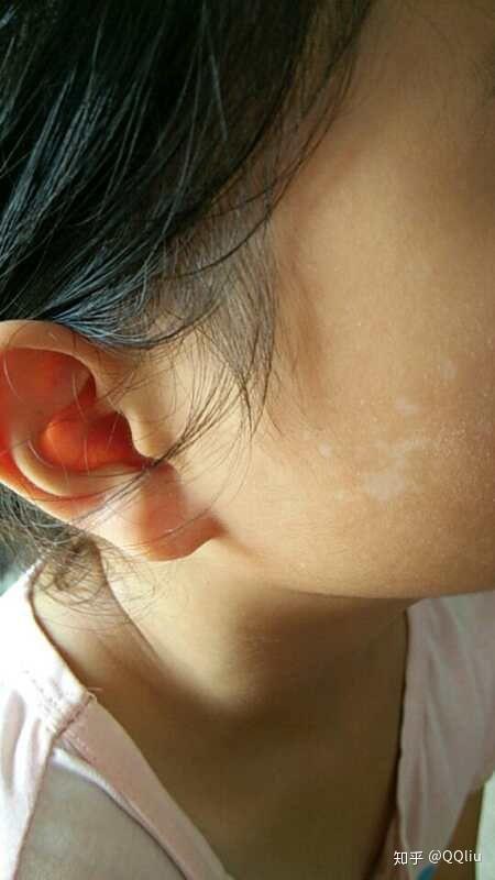 关于汗斑快好的症状是什么还有就是汗斑一定有皮屑吗