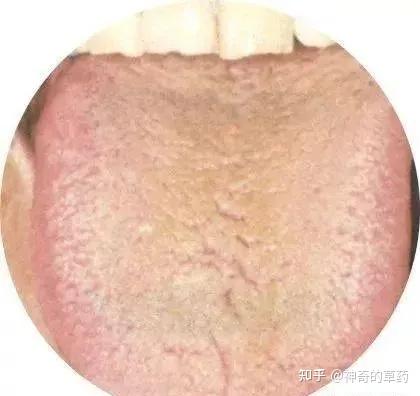 舌诊图谱130种(建议收藏) - 知乎